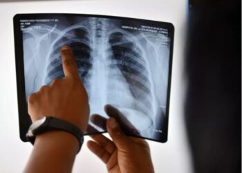 Dia de combate à tuberculose: o que é e quais são os sintomas, diagnóstico e tratamento