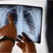 Dia de combate à tuberculose: o que é e quais são os sintomas, diagnóstico e tratamento
