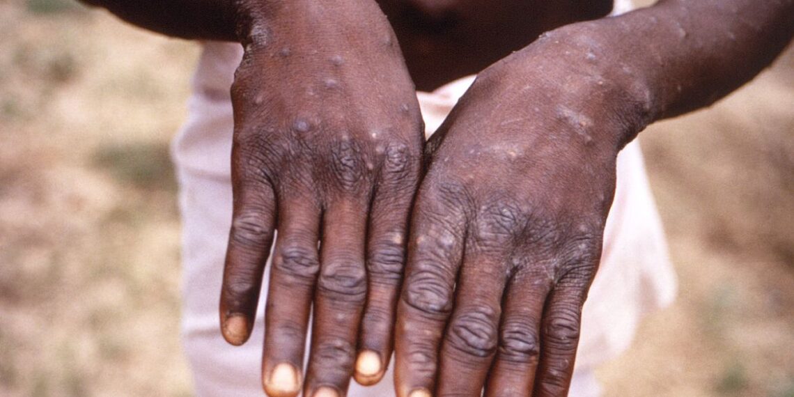 Brasil cria comissão para acompanhar casos de varíola de macacos