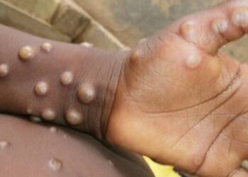 Varíola dos macacos deve chegar ‘pontualmente’, diz secretário de Saúde de Minas Gerais