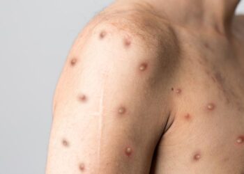 Profissionais da rede de saúde de Poços passarão por treinamento sobre a varíola dos macacos