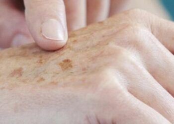 Dezembro Laranja: Unimed Poços alerta sobre diagnósticos de câncer de pele