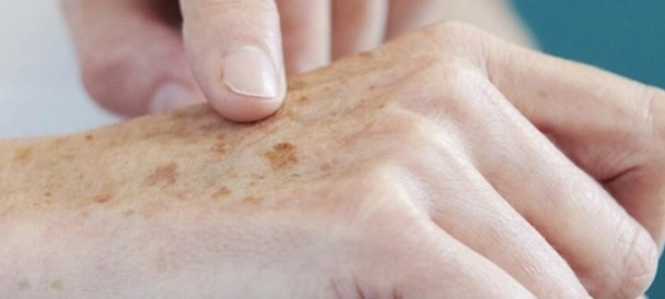 Dezembro Laranja: Unimed Poços alerta sobre diagnósticos de câncer de pele