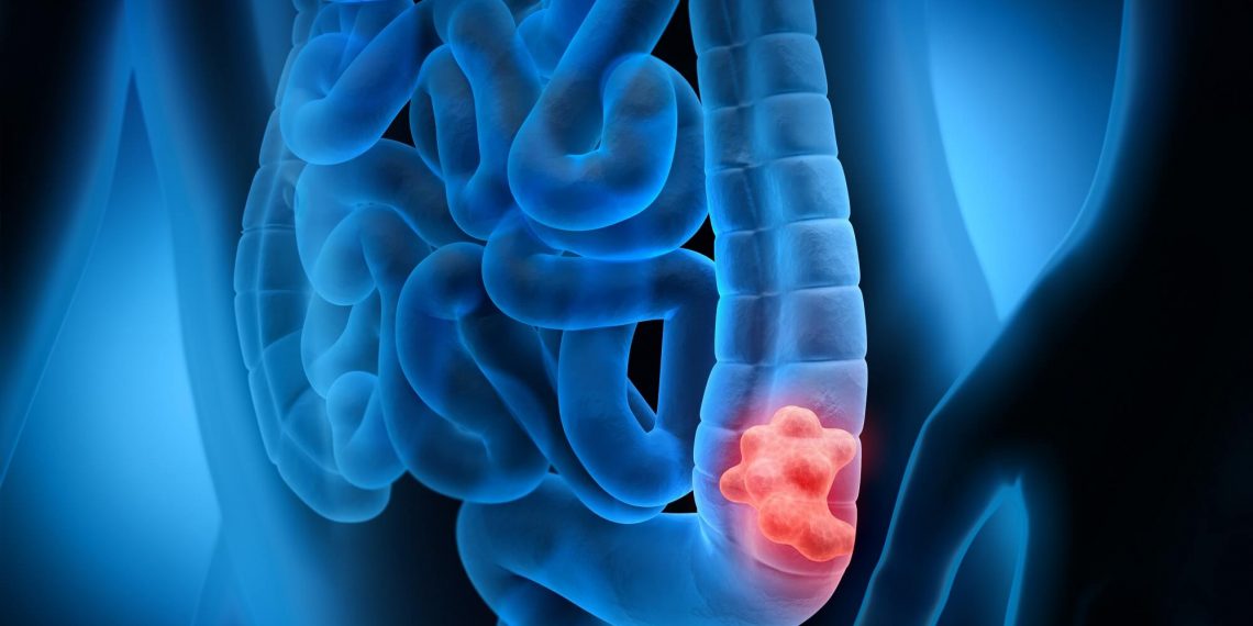 Projeto de Lei em Poços sugere criação da campanha “Março Azul Marinho”, sobre câncer de intestino