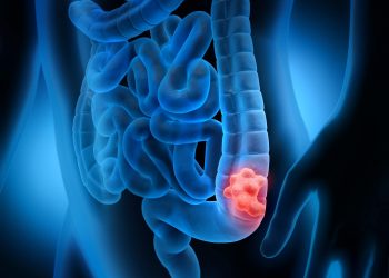 Projeto de Lei em Poços sugere criação da campanha “Março Azul Marinho”, sobre câncer de intestino