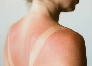 Dermatologista comenta sobre exposição indevida ao sol
