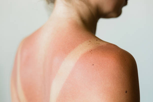 Dermatologista comenta sobre exposição indevida ao sol