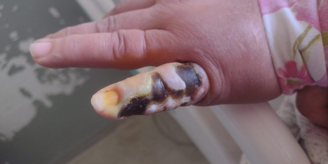 Mulher é hospitalizada após picada de aranha em Poços de Caldas