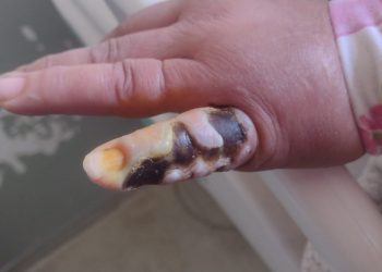 Mulher é hospitalizada após picada de aranha em Poços de Caldas