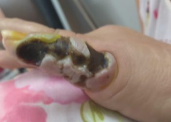 Poços de Caldas já registrou 26 casos de picadas por aranhas em 2023