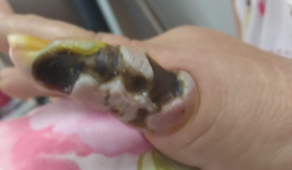 Poços de Caldas já registrou 26 casos de picadas por aranhas em 2023