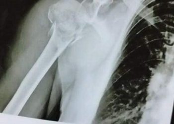 Mulher tem braço quebrado após cair de brinquedo na Eapic em São João da Boa Vista