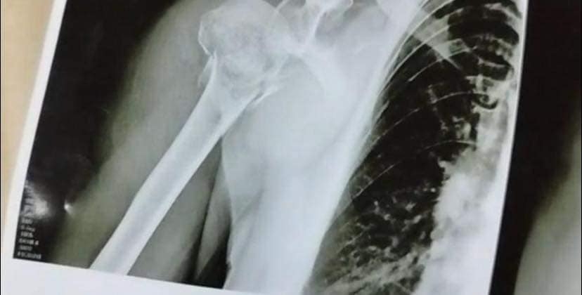 Mulher tem braço quebrado após cair de brinquedo na Eapic em São João da Boa Vista