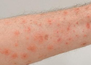 Aulas são canceladas após casos de sarna humana em Poços Fundo