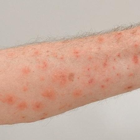 Aulas são canceladas após casos de sarna humana em Poços Fundo