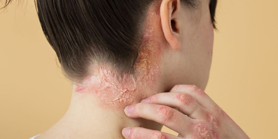 Doença Mpox: OMS emite alerta global