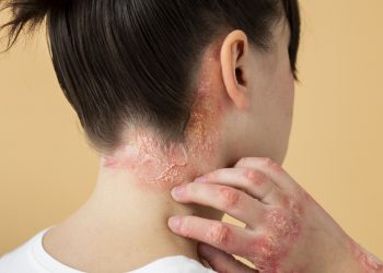 Doença Mpox: OMS emite alerta global