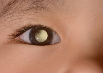 Campanha contra câncer de retina acontece neste final de semana (21) em Poços de Caldas