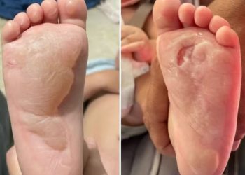 Bebê de 1 ano sofre queimaduras nos pés em creche de São João da Boa Vista