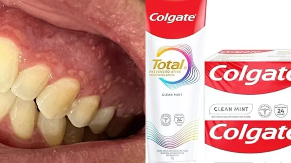 Colgate Total Clean Mint tem interdição suspensa pela Anvisa e volta a ser vendido
