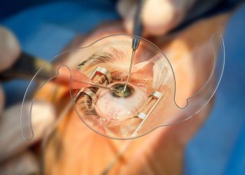 Prefeitura de Poços de Caldas realiza mutirões de cirurgia de catarata e reduz fila de espera