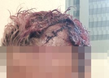 Homem leva cinco pontos na cabeça após ser agredido com cadeirada em Poços de Caldas