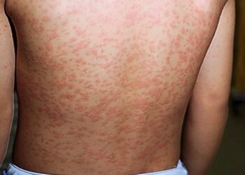 Casos de sarampo tiveram aumento de 34 vezes em 2025, alerta Opas