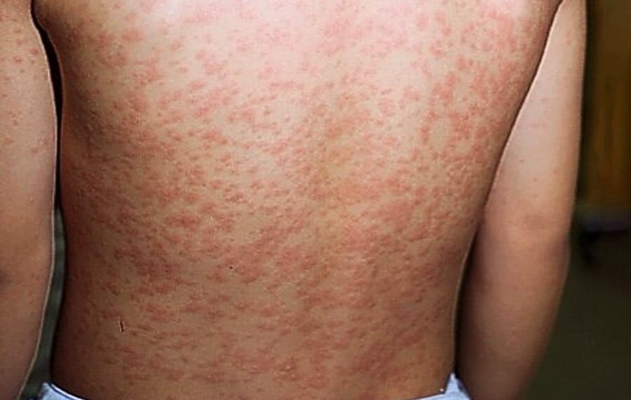 Casos de sarampo tiveram aumento de 34 vezes em 2025, alerta Opas