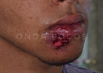 Jovem diz que levou tiro de borracha na boca e acusa PM de tentar mudar versão