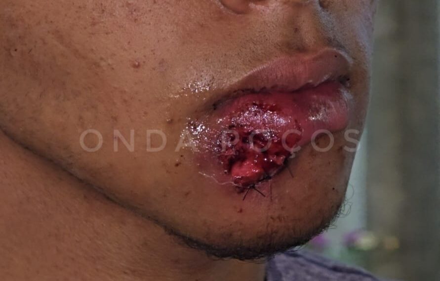 Jovem diz que levou tiro de borracha na boca e acusa PM de tentar mudar versão