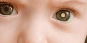 Poços recebe campanha nacional de prevenção ao câncer ocular infantil