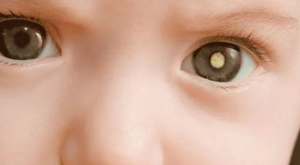 Poços recebe campanha nacional de prevenção ao câncer ocular infantil