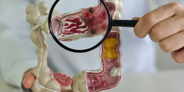 Casos de doenças inflamatórias intestinais crescem cinco vezes no Brasil