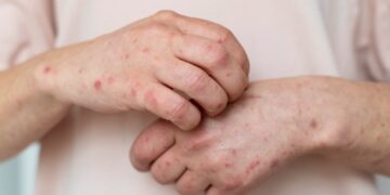 Sarna em Poços de Caldas: veja sintomas e como prevenir